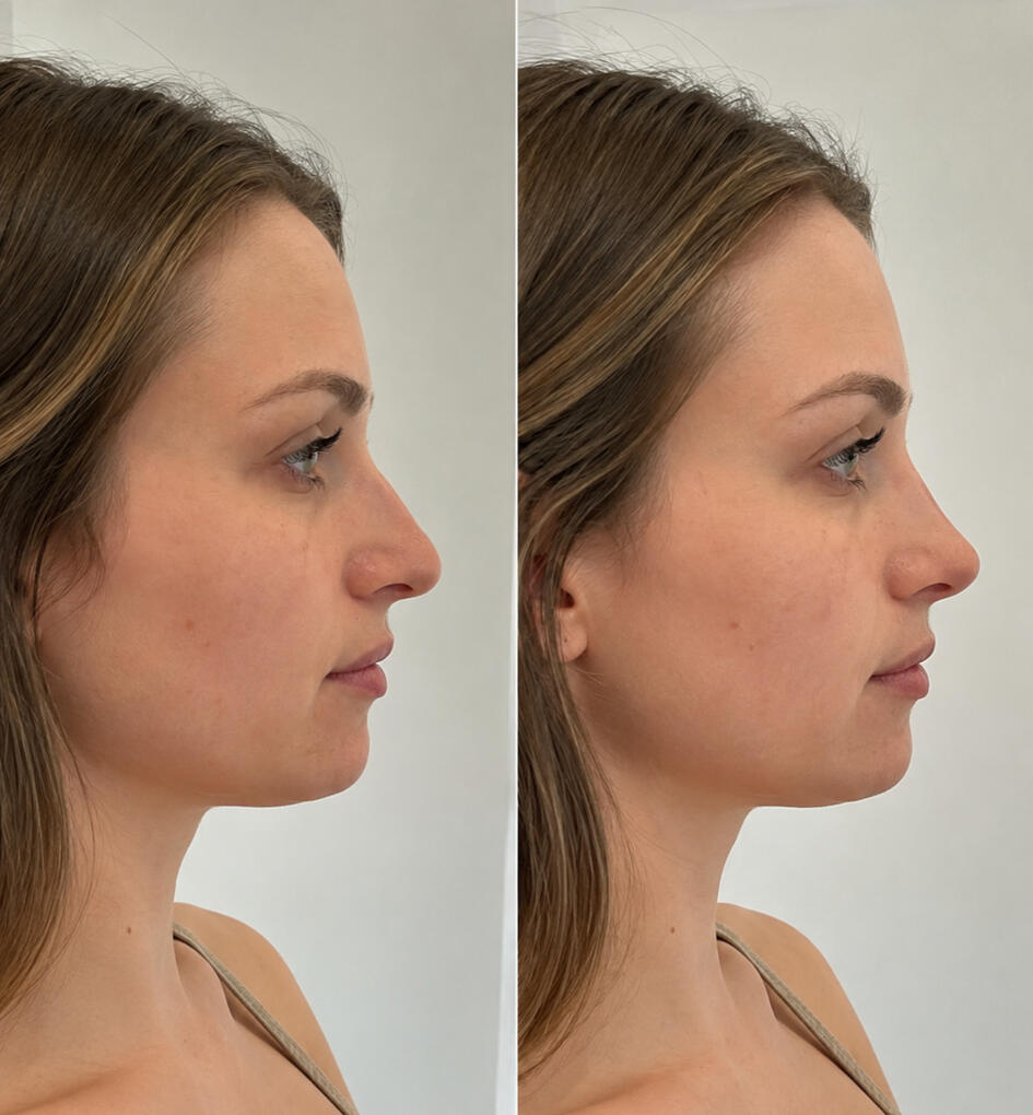 Profile Balancing