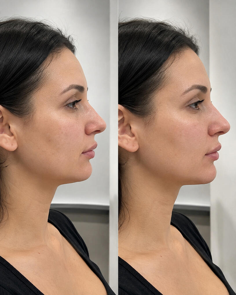 Profile Refinement Profile Refinement